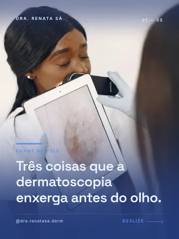 Três coisas que a dermatoscopia enxerga antes do olho.
